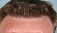 Before Hair Transplant&nbsp;Hairlines